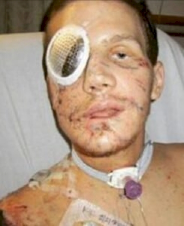 Heroic Marine Jumps on Live Grenade to Save Comrade – You Won’t Believe What Happened Next!